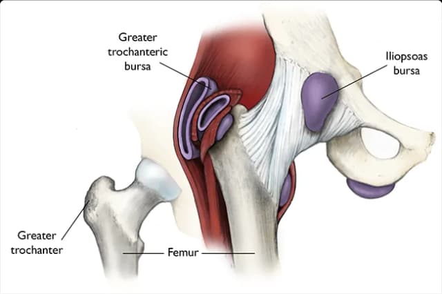 Causas y tratamientos del dolor en los músculos de la cadera Causas y tratamientos del dolor en los músculos de la cadera