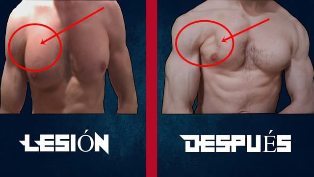 Desgarro muscular en el pecho: síntomas, causas y tratamientos efectivos Desgarro muscular en el pecho: síntomas, causas y tratamientos efectivos