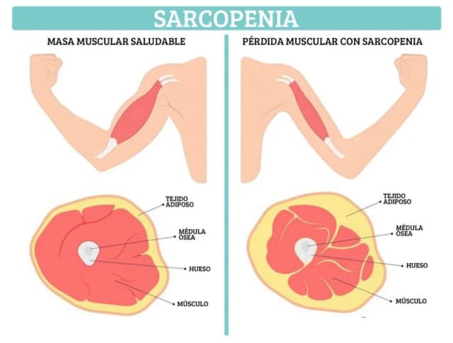 Cómo prevenir la pérdida de masa muscular y mejorar tu calidad de vida Cómo prevenir la pérdida de masa muscular y mejorar tu calidad de vida
